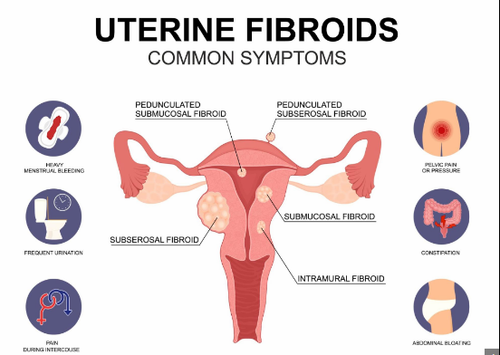 Fibroids and Menstrual Problems
